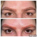 Pros and Cons of Laser Removal for Eyebrow Tattoos