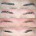 Understanding Laser Removal for Eyebrow Tattoos