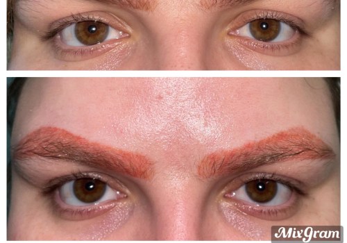 Pros and Cons of Laser Removal for Eyebrow Tattoos