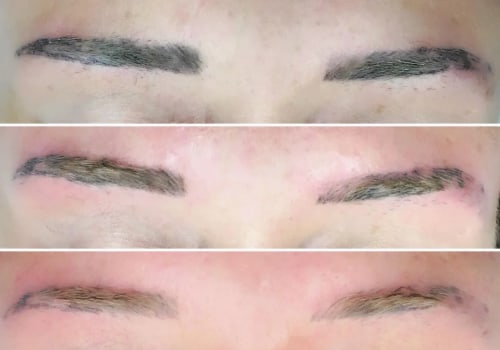 Understanding Laser Removal for Eyebrow Tattoos